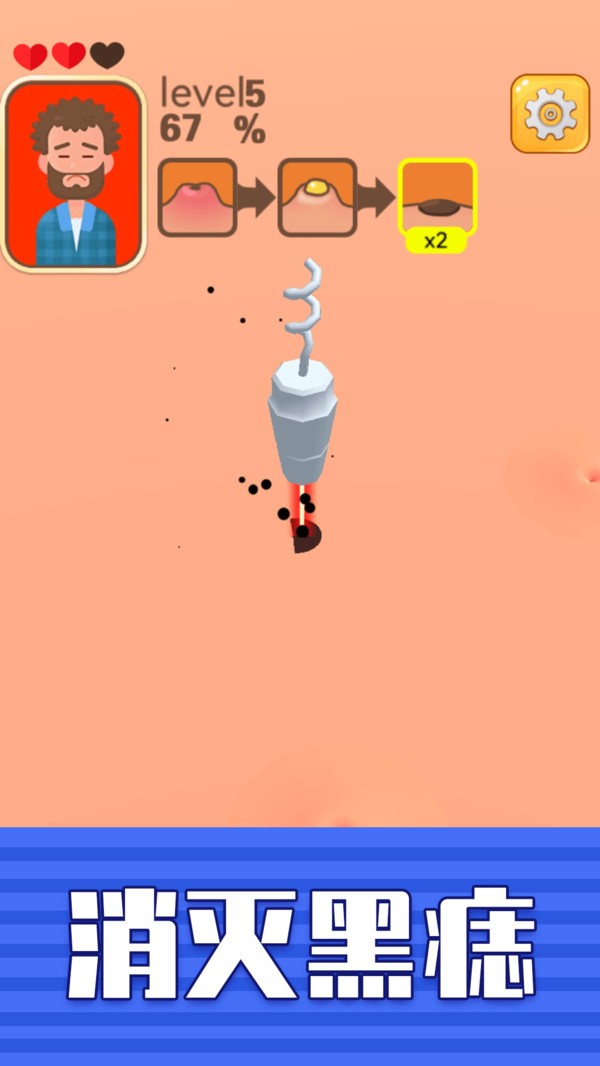 挤痘贼爽小游戏 v1.0.0 安卓版0