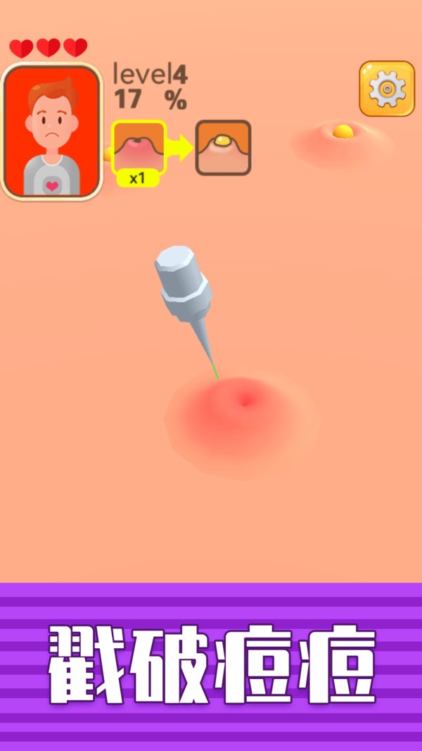 挤痘贼爽小游戏 v1.0.0 安卓版1